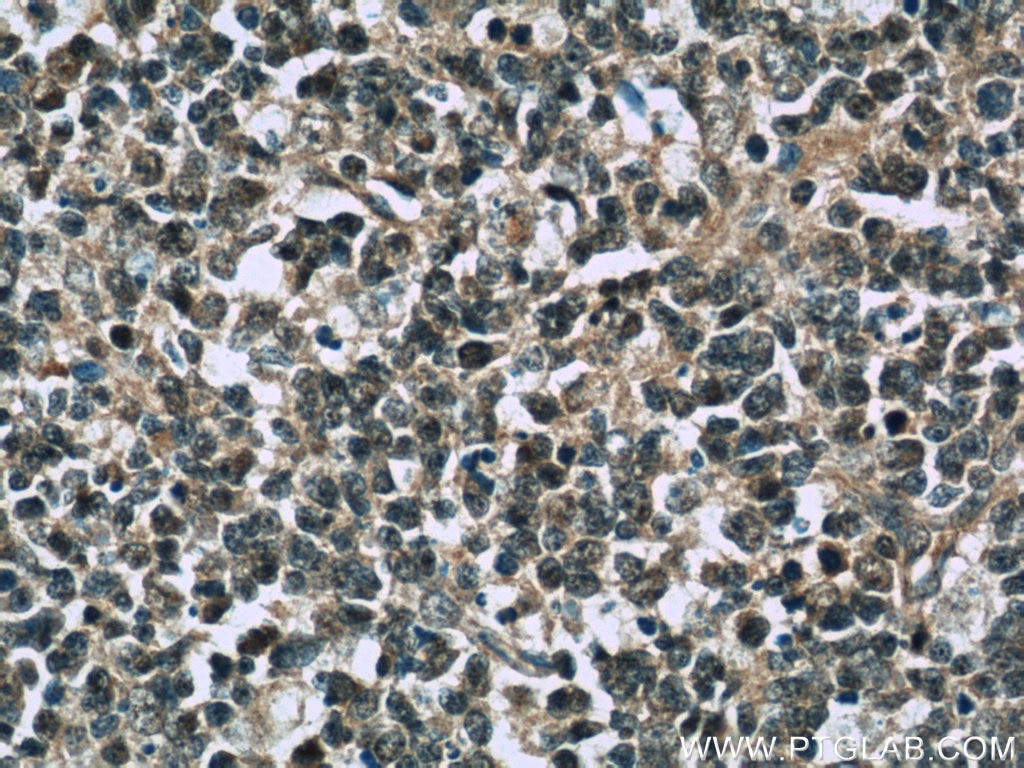Immunohistochemistry (IHC) staining of human tonsillitis tissue using TFPT Polyclonal antibody (10097-2-AP)