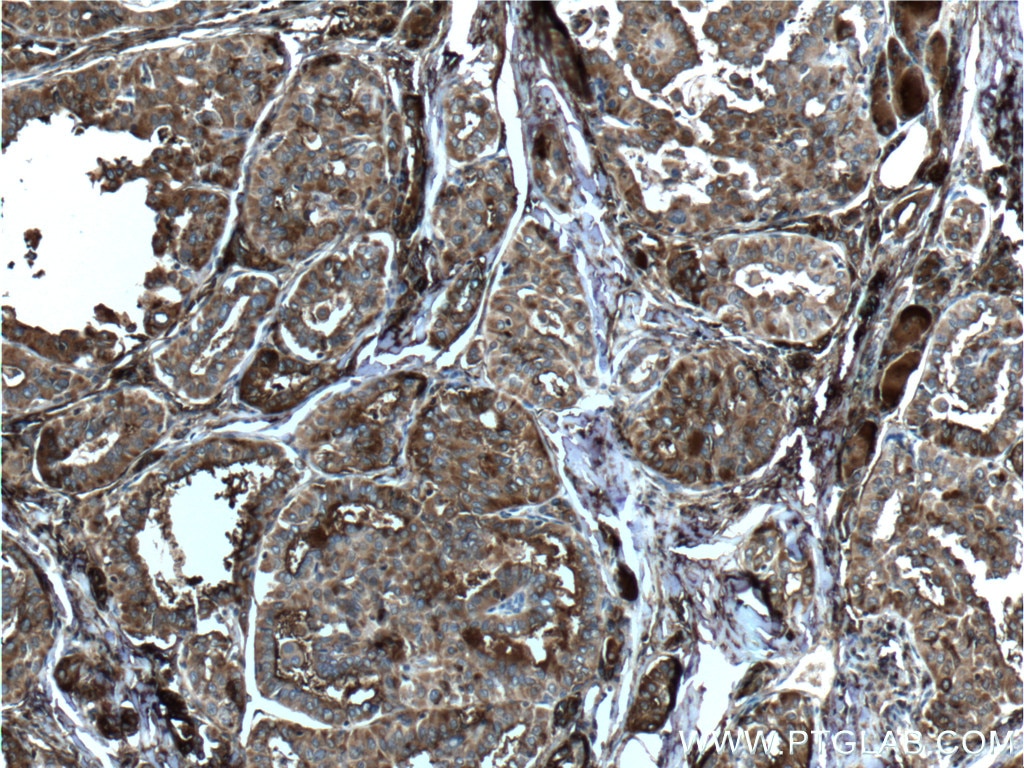 IHC staining of human thyroid cancer using 21714-1-AP