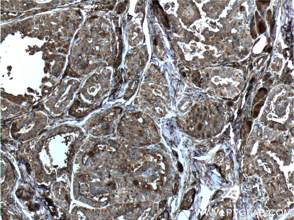 Immunohistochemistry (IHC) staining of human thyroid cancer tissue using Thyroglobulin Polyclonal antibody (21714-1-AP)