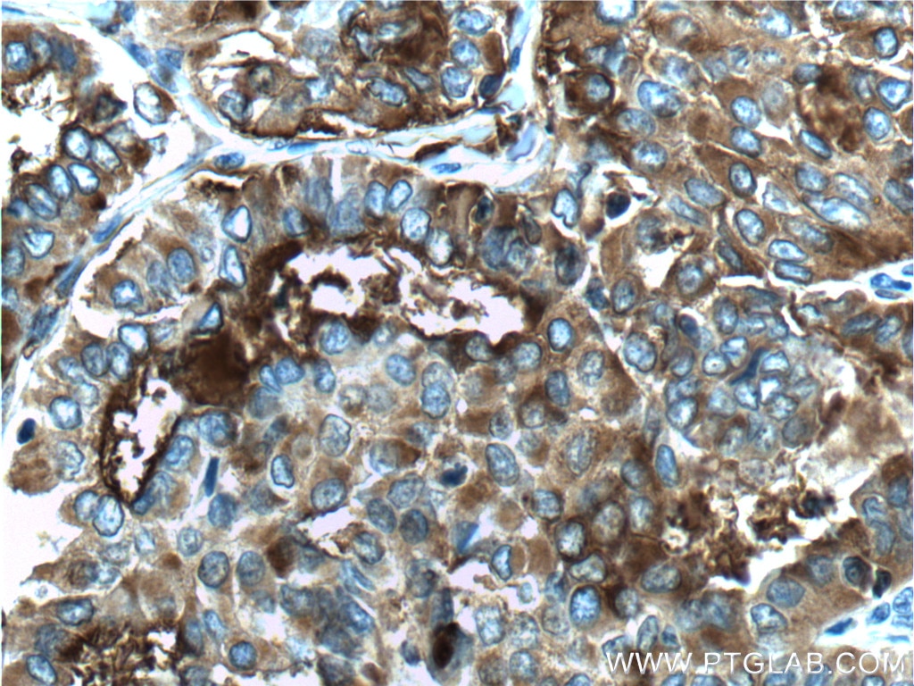 Immunohistochemistry (IHC) staining of human thyroid cancer tissue using Thyroglobulin Polyclonal antibody (21714-1-AP)