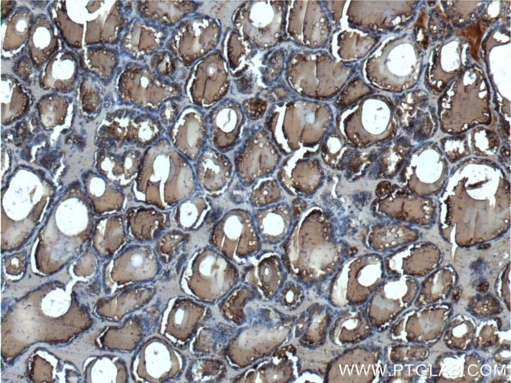 Immunohistochemistry (IHC) staining of human thyroid tissue using Thyroglobulin Polyclonal antibody (21714-1-AP)