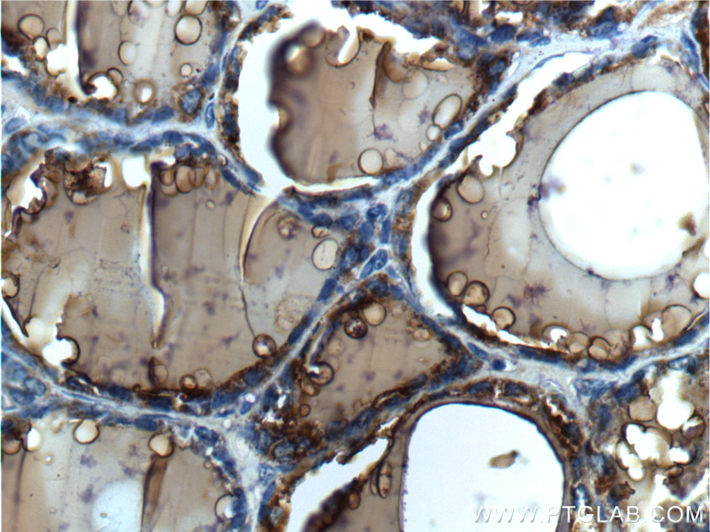 Immunohistochemistry (IHC) staining of human thyroid tissue using Thyroglobulin Polyclonal antibody (21714-1-AP)