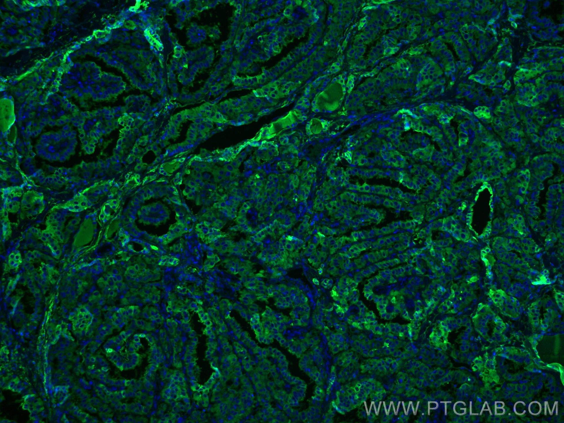 Immunofluorescence (IF) / fluorescent staining of human thyroid cancer tissue using Thyroglobulin Monoclonal antibody (60272-1-Ig)