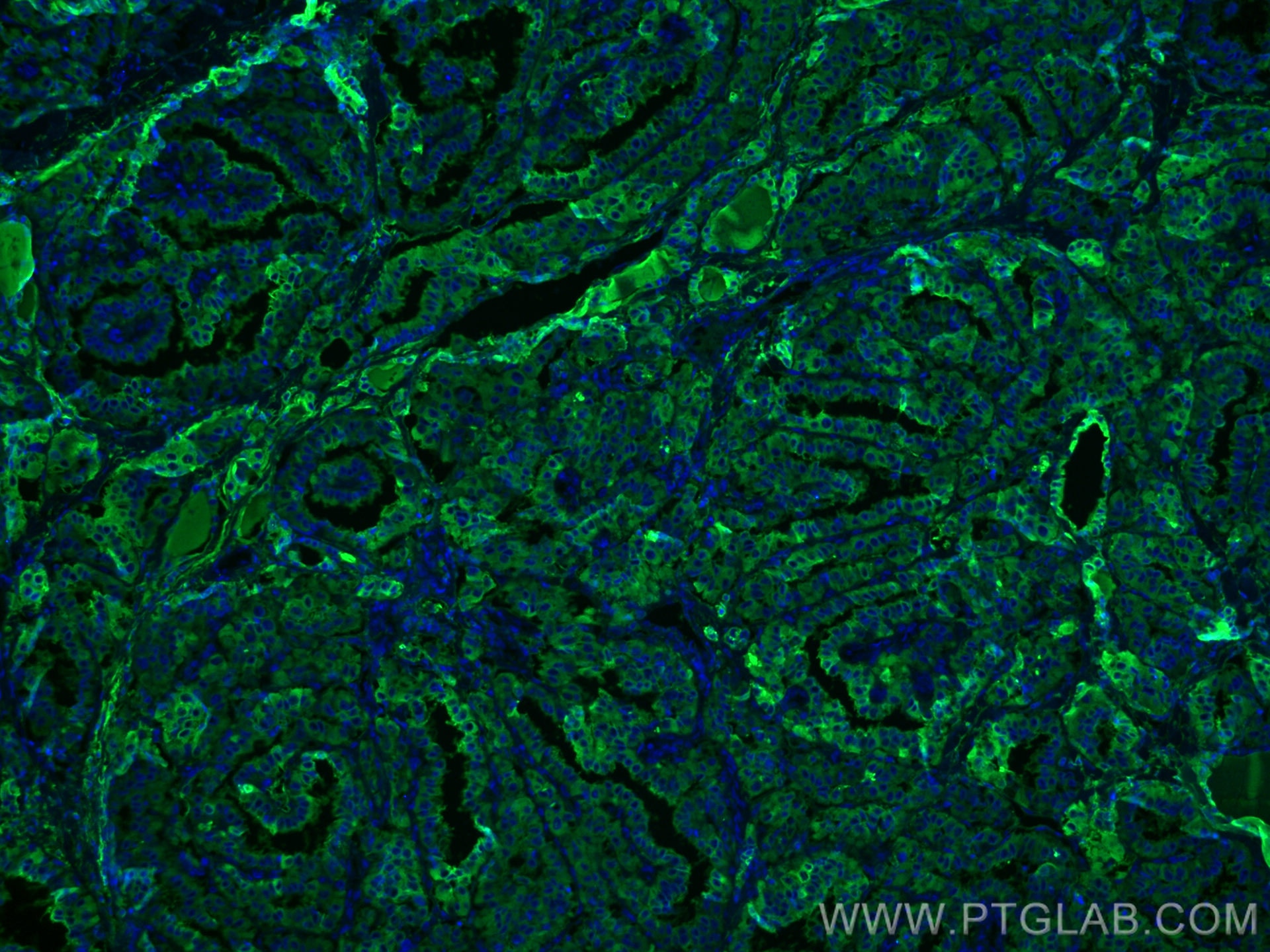 IF Staining of human thyroid cancer using 60272-1-Ig