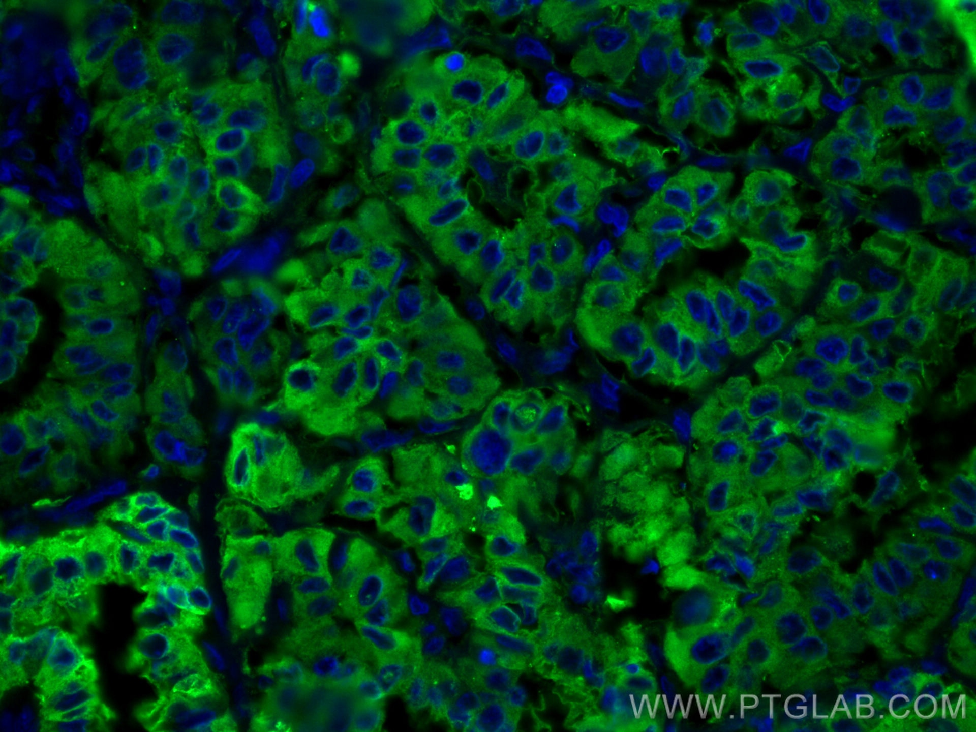 Immunofluorescence (IF) / fluorescent staining of human thyroid cancer tissue using Thyroglobulin Monoclonal antibody (60272-1-Ig)