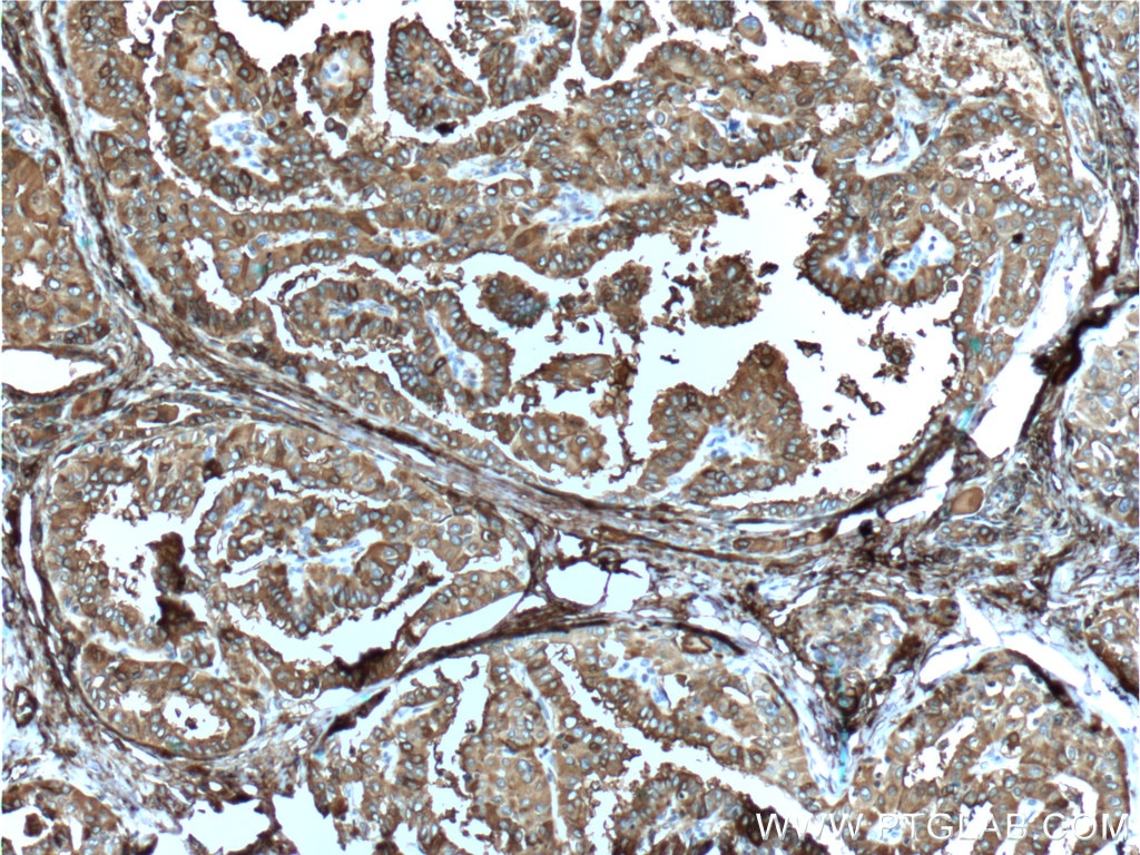 Immunohistochemistry (IHC) staining of human thyroid cancer tissue using Thyroglobulin Monoclonal antibody (60272-1-Ig)