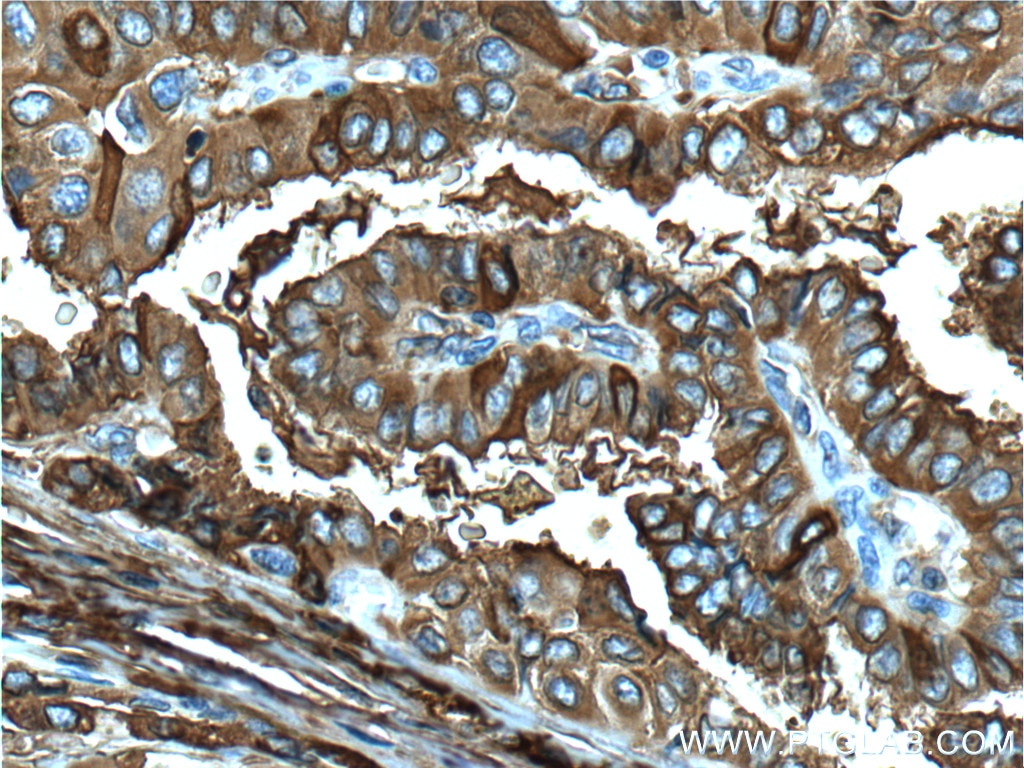 Immunohistochemistry (IHC) staining of human thyroid cancer tissue using Thyroglobulin Monoclonal antibody (60272-1-Ig)