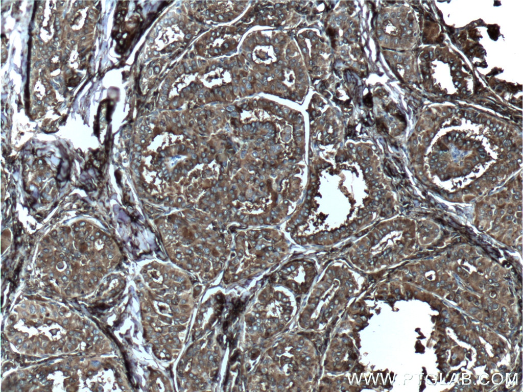 Immunohistochemistry (IHC) staining of human thyroid cancer tissue using Thyroglobulin Monoclonal antibody (60272-1-Ig)