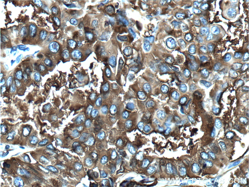 Immunohistochemistry (IHC) staining of human thyroid cancer tissue using Thyroglobulin Monoclonal antibody (60272-1-Ig)