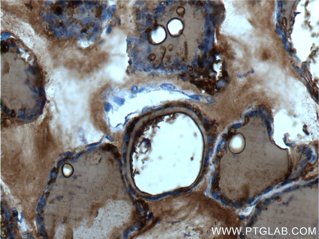 Immunohistochemistry (IHC) staining of human thyroid tissue using Thyroglobulin Monoclonal antibody (60272-1-Ig)