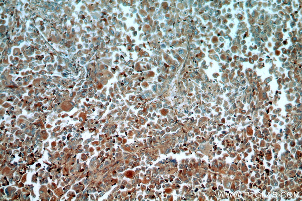 Immunohistochemistry (IHC) staining of human lung cancer tissue using TGDS Polyclonal antibody (17310-1-AP)