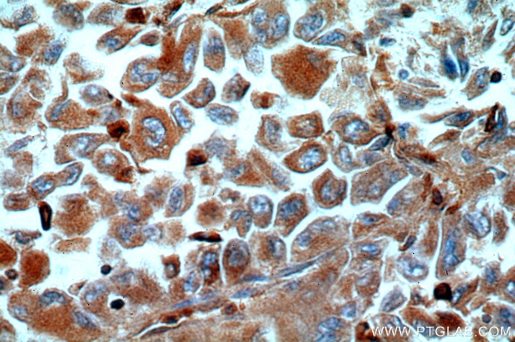 Immunohistochemistry (IHC) staining of human lung cancer tissue using TGDS Polyclonal antibody (17310-1-AP)