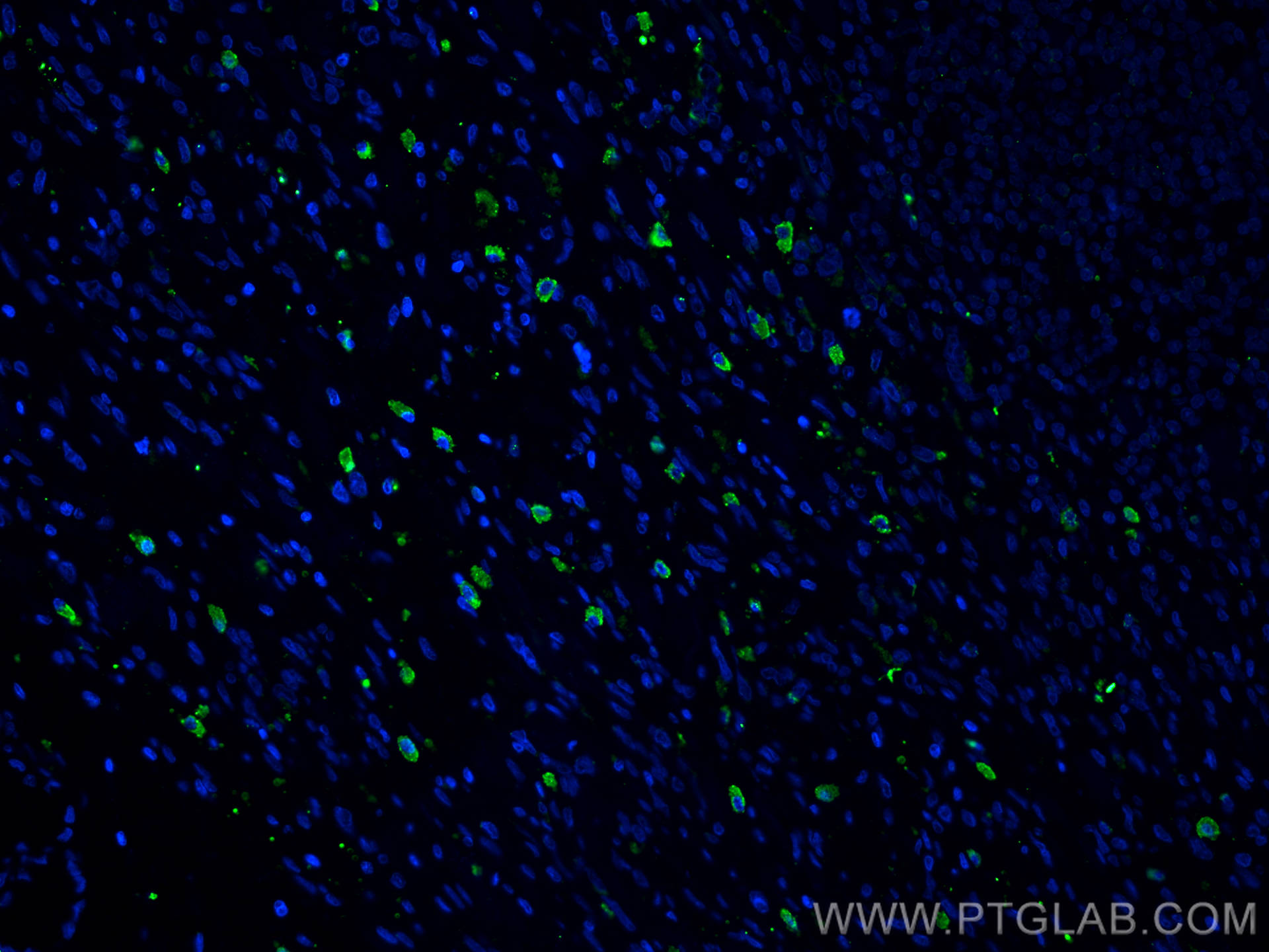 Immunofluorescence (IF) / fluorescent staining of human stomach cancer tissue using TGF Beta 1 Polyclonal antibody (21898-1-AP)