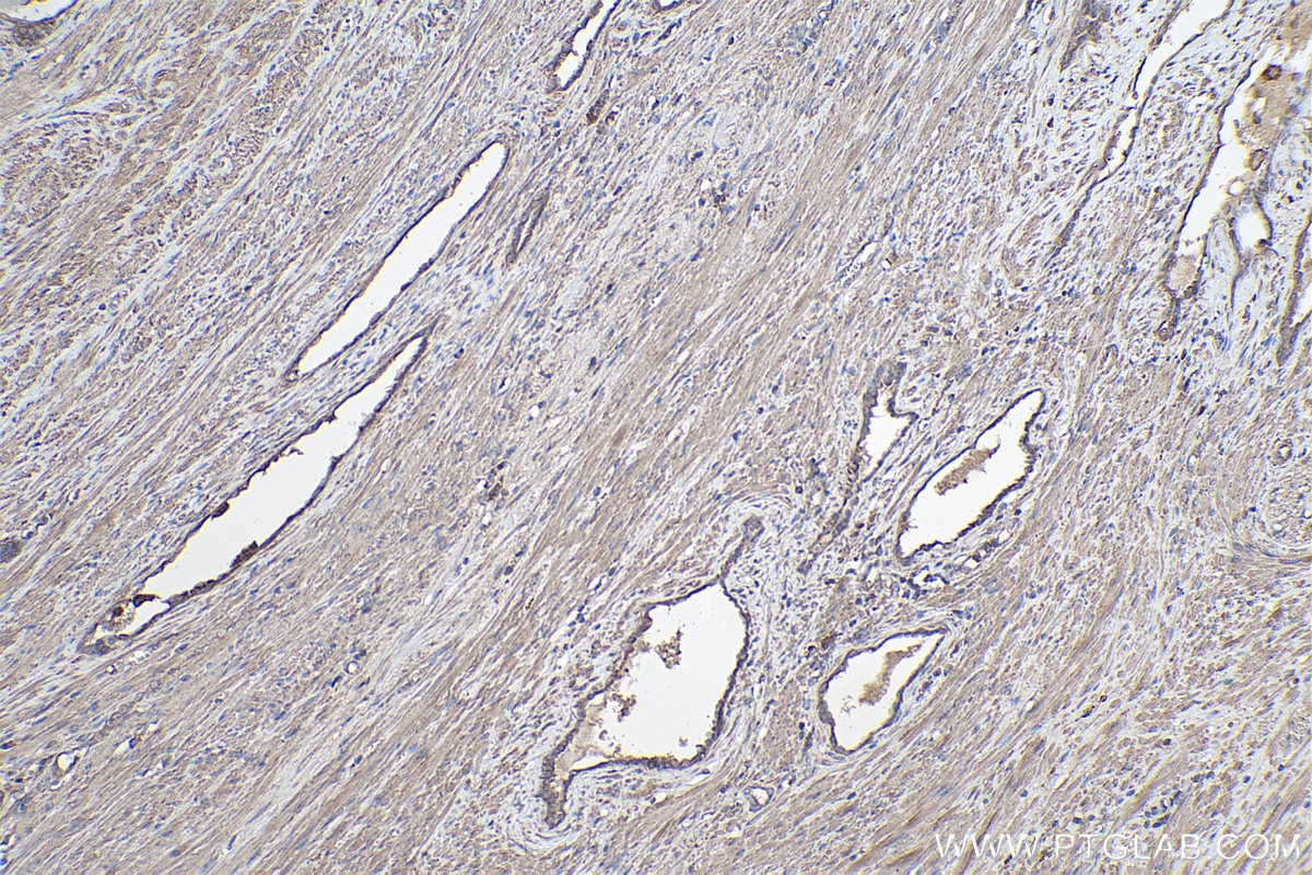 Immunohistochemistry (IHC) staining of human prostate cancer tissue using NeutraKine® TGF beta 1 Monoclonal antibody (69012-1-Ig)