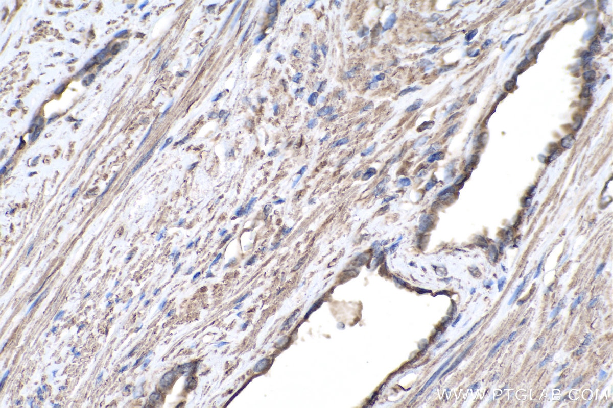 Immunohistochemistry (IHC) staining of human prostate cancer tissue using NeutraKine® TGF beta 1 Monoclonal antibody (69012-1-Ig)
