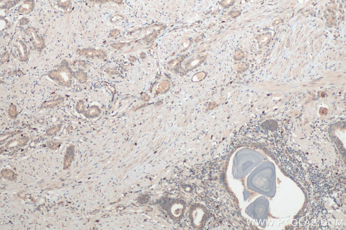 Immunohistochemistry (IHC) staining of human prostate cancer tissue using TGF beta 2 Polyclonal antibody (28426-1-AP)