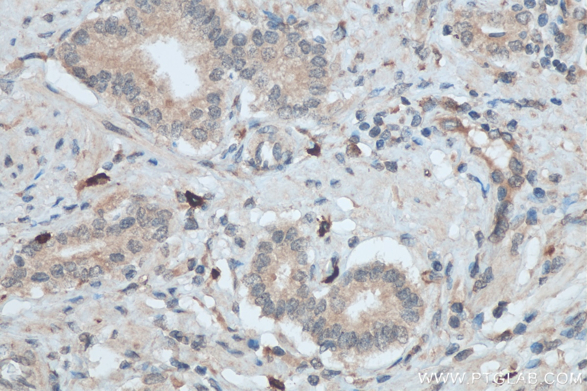 Immunohistochemistry (IHC) staining of human prostate cancer tissue using TGF beta 2 Polyclonal antibody (28426-1-AP)