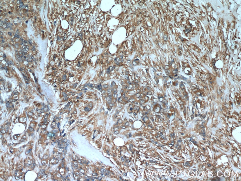 IHC staining of human breast cancer using 22308-1-AP