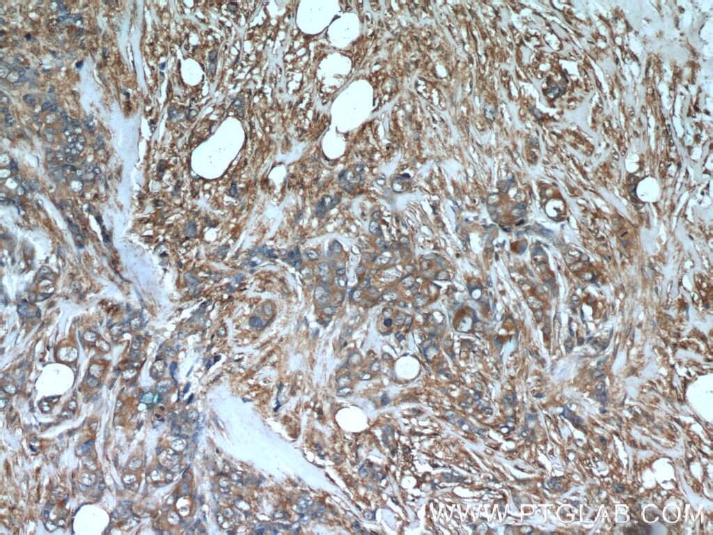 Immunohistochemistry (IHC) staining of human breast cancer tissue using TGF Alpha Polyclonal antibody (22308-1-AP)