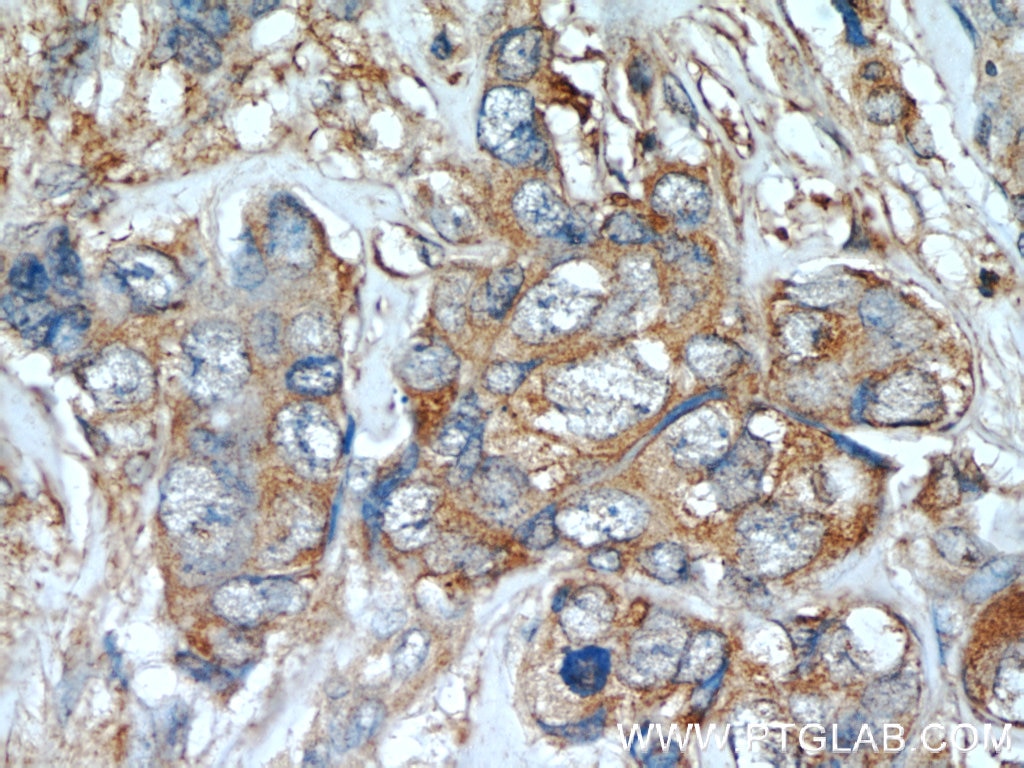 Immunohistochemistry (IHC) staining of human breast cancer tissue using TGF Alpha Polyclonal antibody (22308-1-AP)