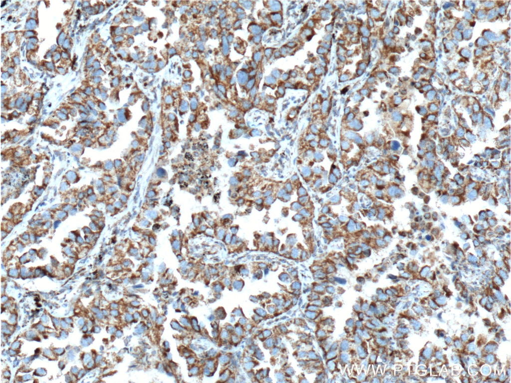 Immunohistochemistry (IHC) staining of human lung cancer tissue using TGF Beta 1 Polyclonal antibody (18978-1-AP)