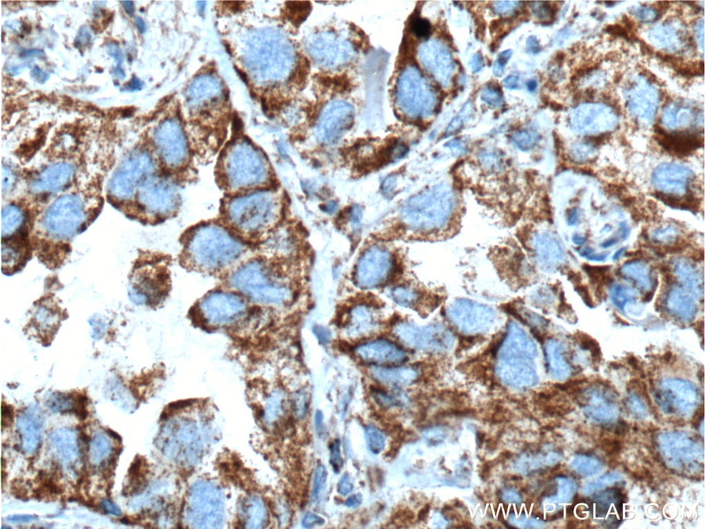 Immunohistochemistry (IHC) staining of human lung cancer tissue using TGF Beta 1 Polyclonal antibody (18978-1-AP)