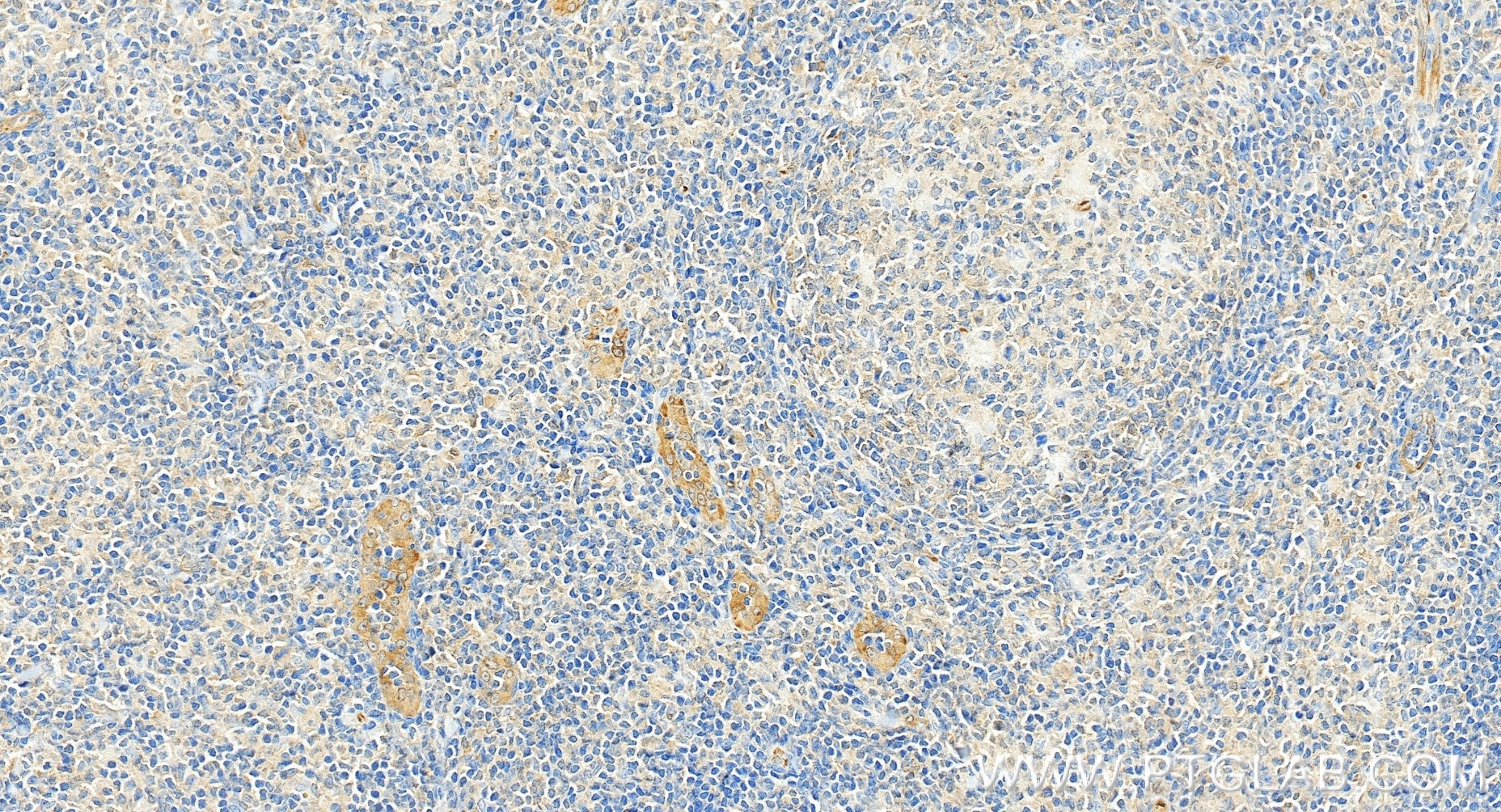 Immunohistochemical analysis of paraffin-embedded human tonsillitis tissue slide using 81746-2-RR (TGF Beta 1 antibody) at dilution of 1:1000 (under 20x lens). Heat mediated antigen retrieval with Tris-EDTA buffer (pH 9.0). Immunohistochemistry (IHC) staining of human tonsillitis tissue using TGF Beta 1 Recombinant monoclonal antibody (81746-2-RR)