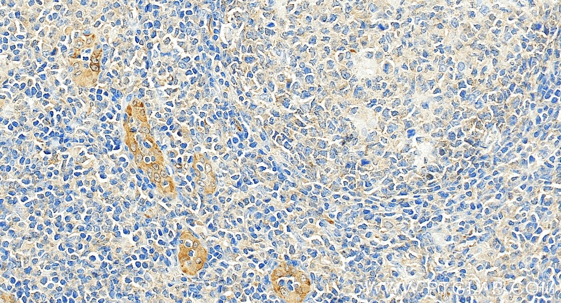 Immunohistochemical analysis of paraffin-embedded human tonsillitis tissue slide using 81746-2-RR (TGF Beta 1 antibody) at dilution of 1:1000 (under 20x lens). Heat mediated antigen retrieval with Tris-EDTA buffer (pH 9.0). Immunohistochemistry (IHC) staining of human tonsillitis tissue using TGF Beta 1 Recombinant monoclonal antibody (81746-2-RR)
