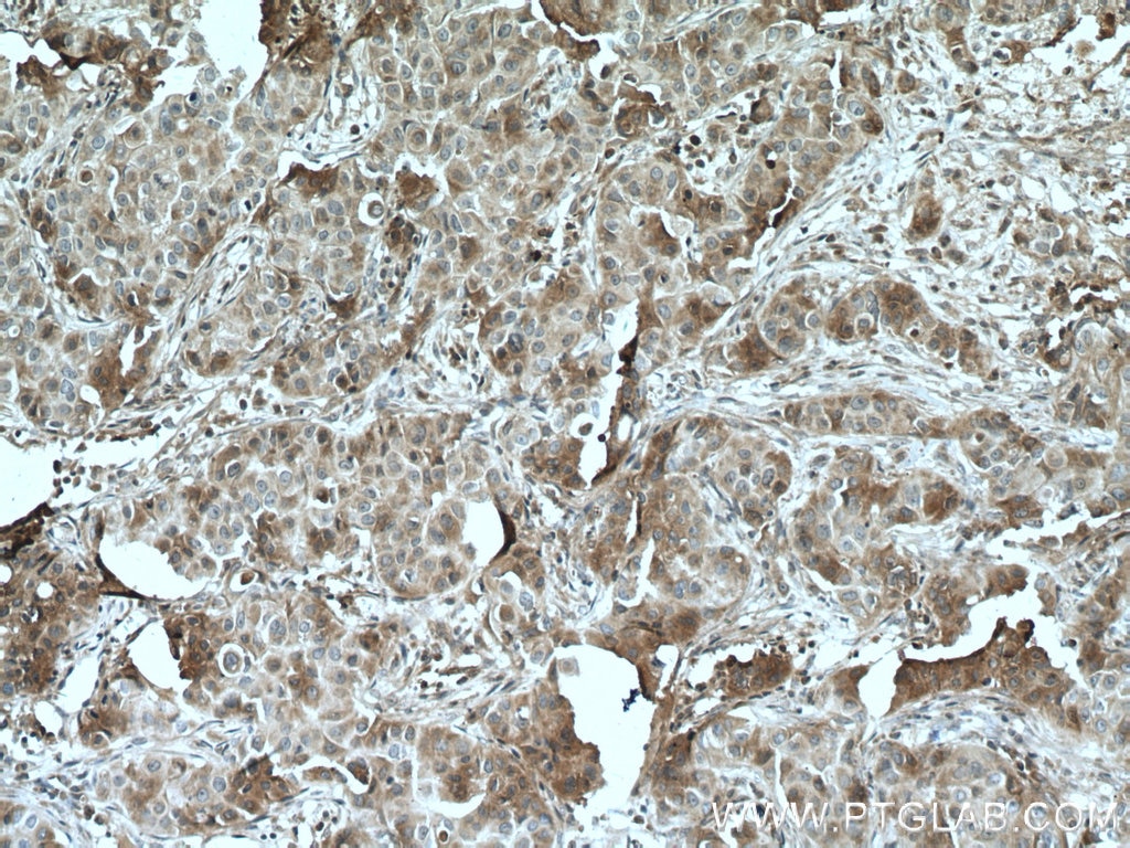 Immunohistochemistry (IHC) staining of human breast cancer tissue using TGF beta 2-Specific Polyclonal antibody (19999-1-AP)