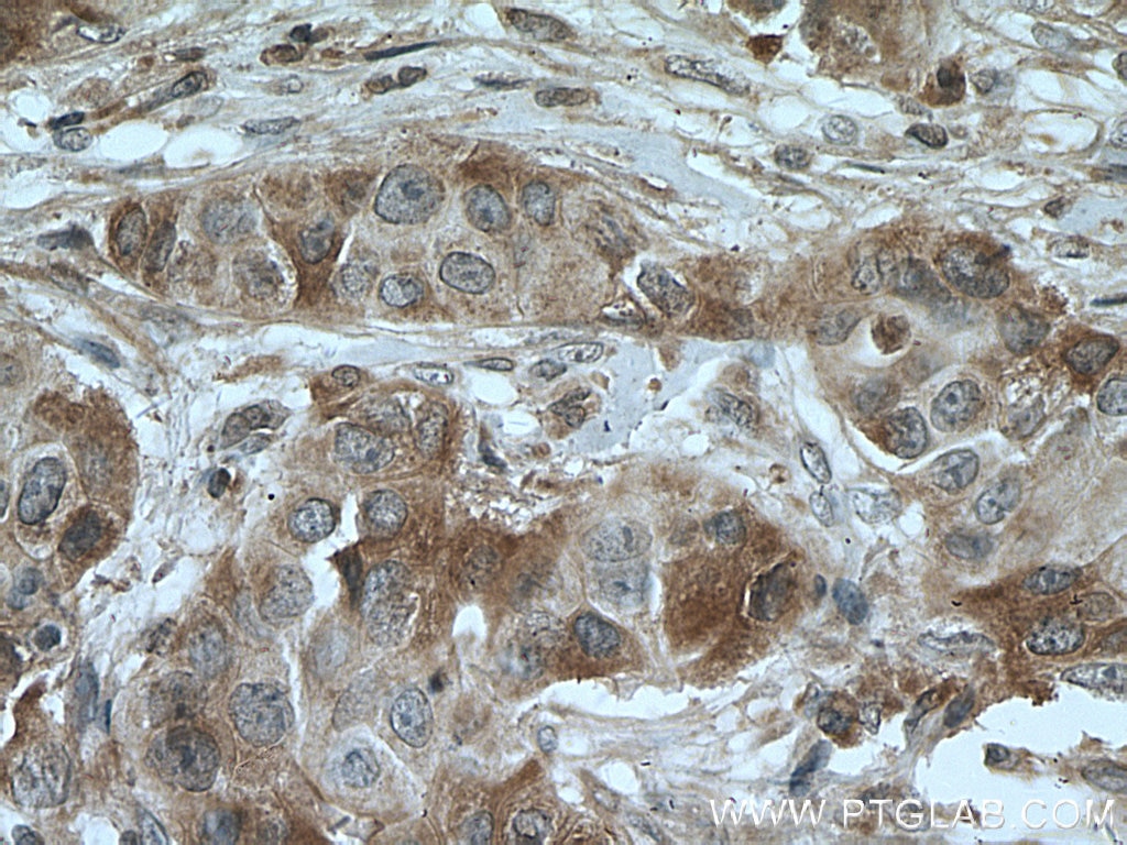 Immunohistochemistry (IHC) staining of human breast cancer tissue using TGF beta 2-Specific Polyclonal antibody (19999-1-AP)