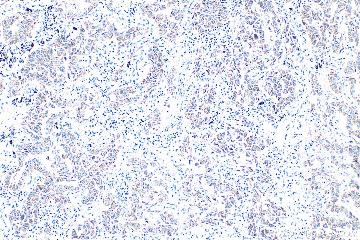 Immunohistochemical analysis of paraffin-embedded human lung cancer tissue slide using 19999-1-AP (TGF beta 2-Specific antibody) at dilution of 1:400 (under 10x lens). Heat mediated antigen retrieval with Tris-EDTA buffer (pH 9.0). Immunohistochemistry (IHC) staining of human lung cancer tissue using TGF beta 2-Specific Polyclonal antibody (19999-1-AP)