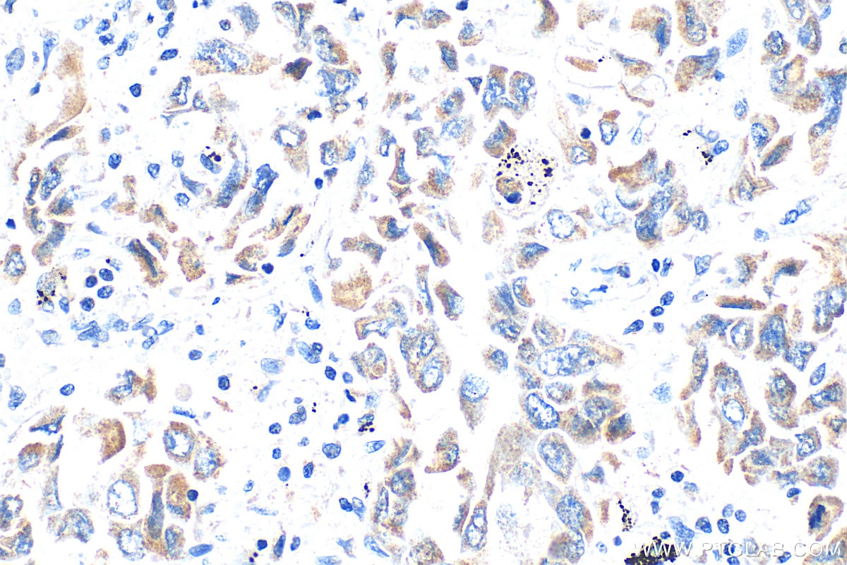Immunohistochemical analysis of paraffin-embedded human lung cancer tissue slide using 19999-1-AP (TGF beta 2-Specific antibody) at dilution of 1:400 (under 40x lens). Heat mediated antigen retrieval with Tris-EDTA buffer (pH 9.0). Immunohistochemistry (IHC) staining of human lung cancer tissue using TGF beta 2-Specific Polyclonal antibody (19999-1-AP)