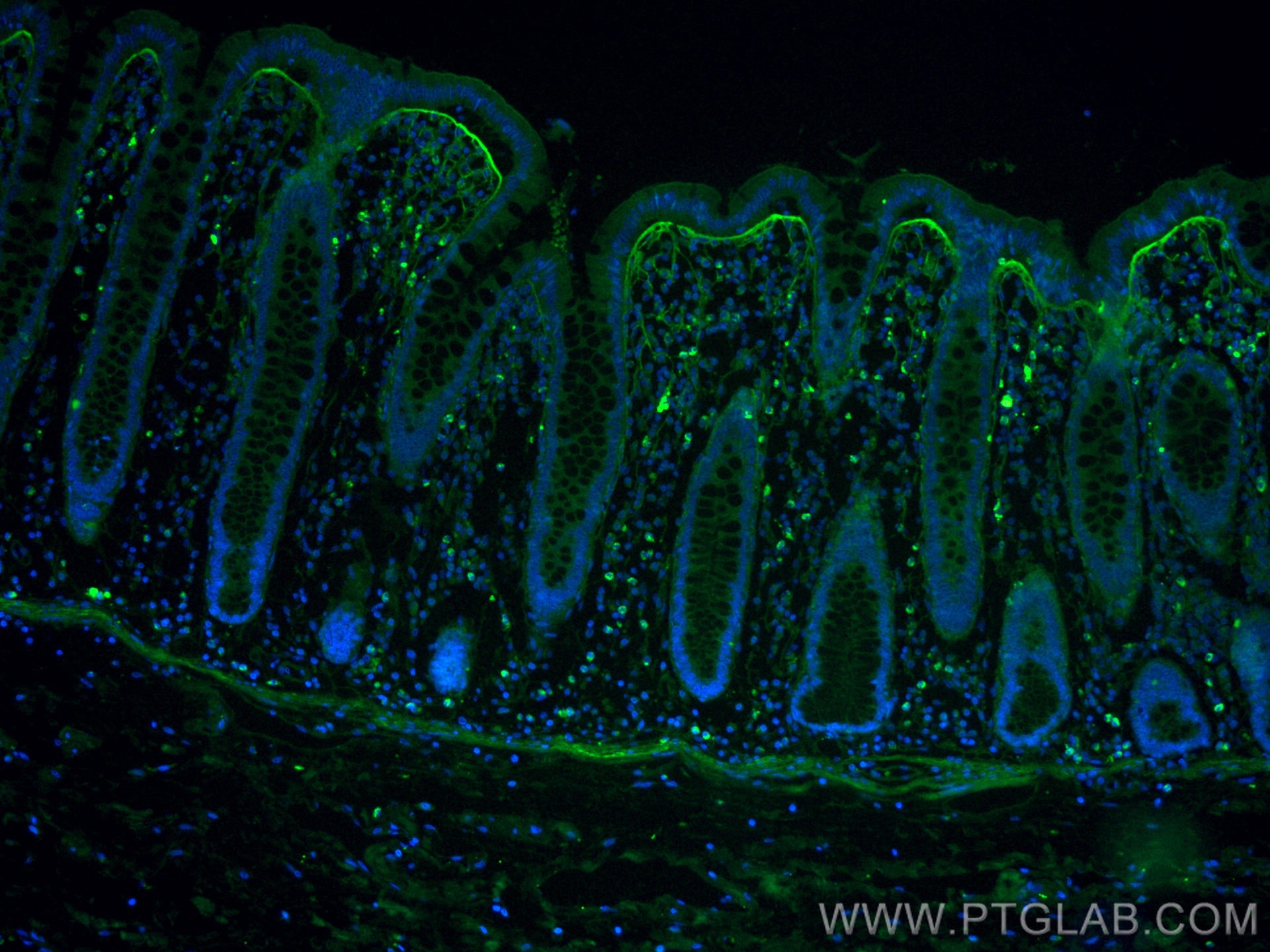 Immunofluorescence (IF) / fluorescent staining of human colon cancer tissue using CoraLite® Plus 488-conjugated TGFBI / BIGH3 Monocl (CL488-60007)