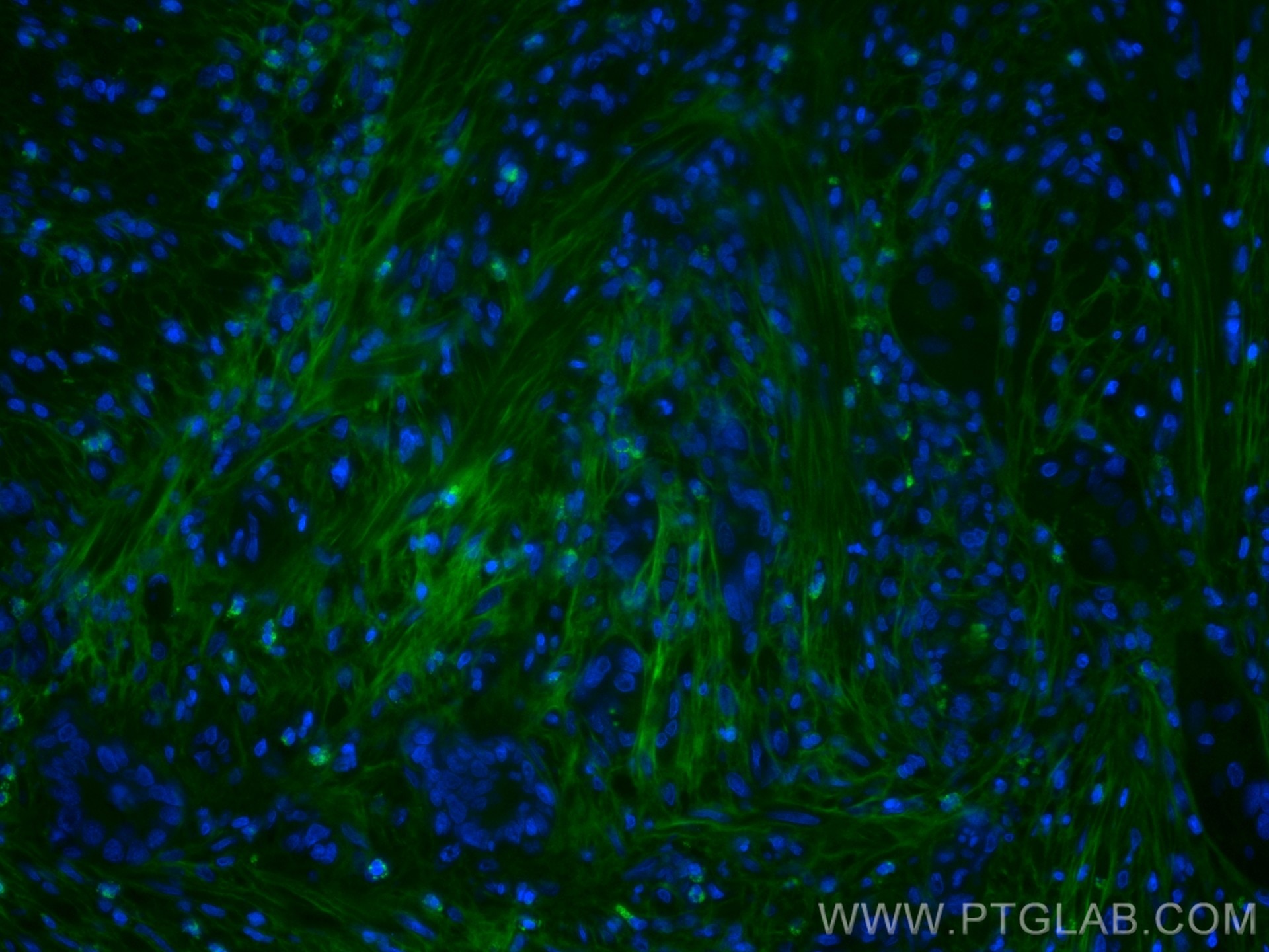 Immunofluorescence (IF) / fluorescent staining of human colon cancer tissue using CoraLite® Plus 488-conjugated TGFBI / BIGH3 Monocl (CL488-60007)