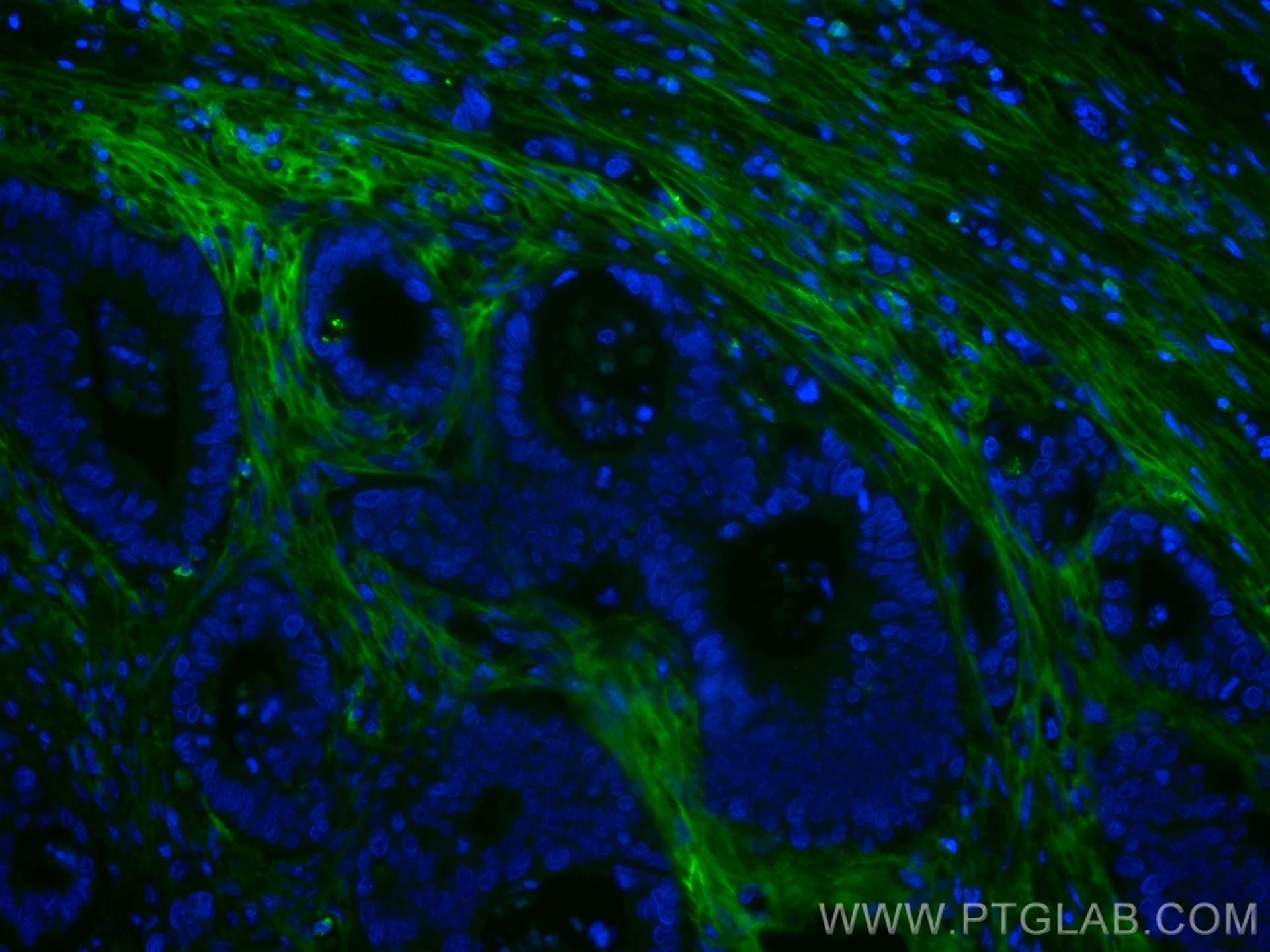 Immunofluorescence (IF) / fluorescent staining of human colon cancer tissue using CoraLite® Plus 488-conjugated TGFBI / BIGH3 Monocl (CL488-60007)