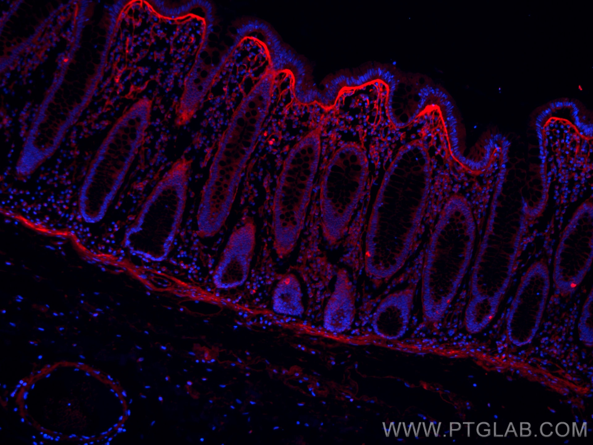 Immunofluorescence (IF) / fluorescent staining of human colon cancer tissue using CoraLite®594-conjugated TGFBI / BIGH3 Monoclonal a (CL594-60007)