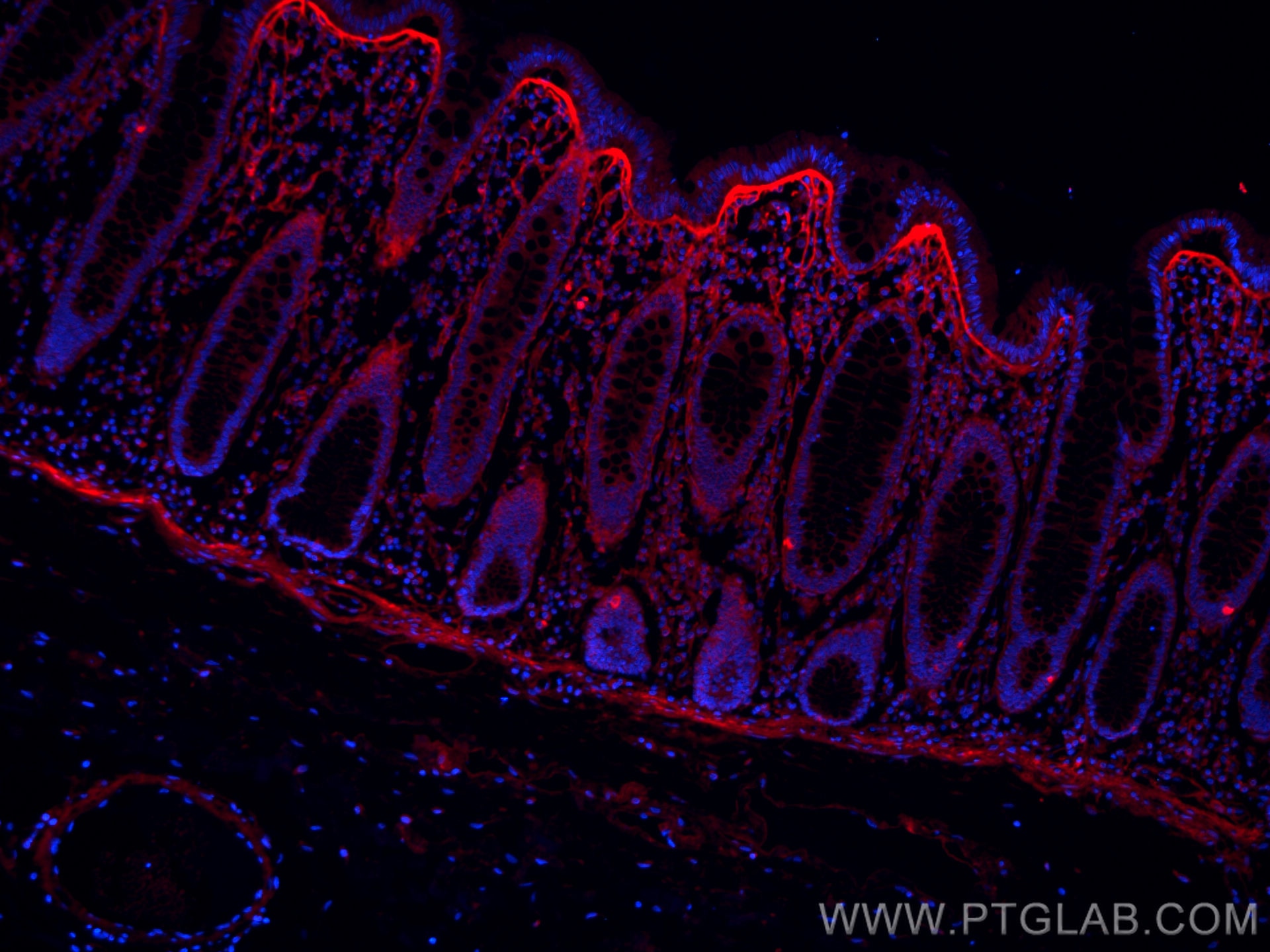 IF Staining of human colon cancer using CL594-60007