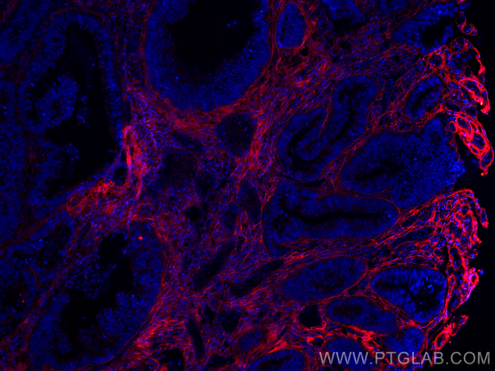 Immunofluorescence (IF) / fluorescent staining of human colon cancer tissue using CoraLite®594-conjugated TGFBI / BIGH3 Monoclonal a (CL594-60007)