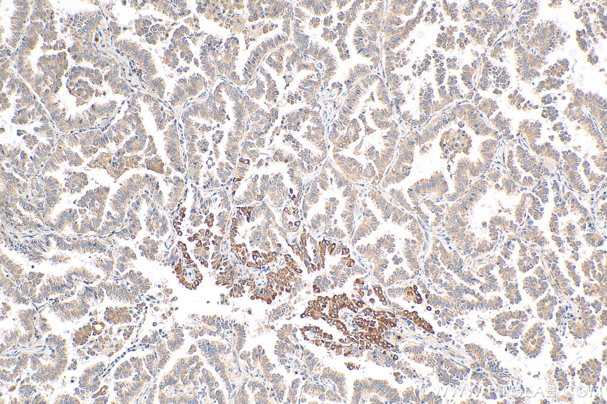 Immunohistochemistry (IHC) staining of human lung cancer tissue using TGFBR1 Polyclonal antibody (30117-1-AP)