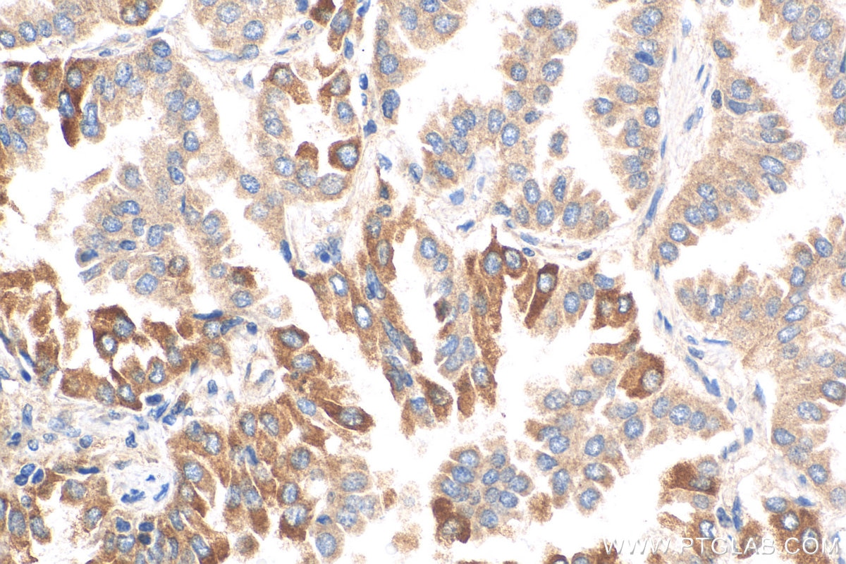 IHC staining of human lung cancer using 30117-1-AP