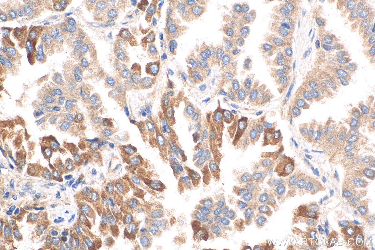 Immunohistochemistry (IHC) staining of human lung cancer tissue using TGFBR1 Polyclonal antibody (30117-1-AP)