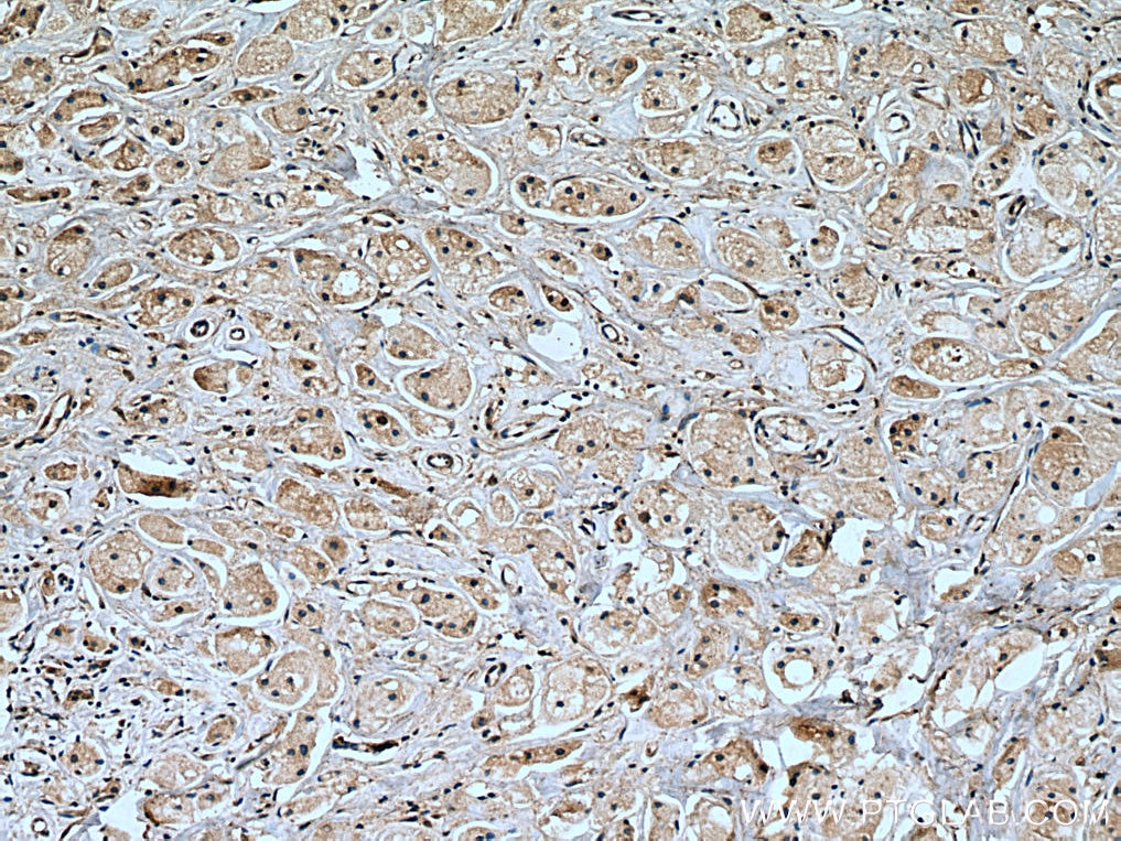 Immunohistochemistry (IHC) staining of human breast cancer tissue using TGFBR2 Monoclonal antibody (66636-1-Ig)