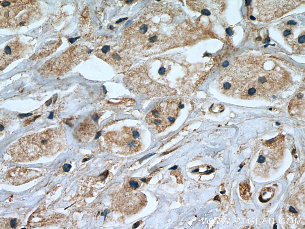 Immunohistochemistry (IHC) staining of human breast cancer tissue using TGFBR2 Monoclonal antibody (66636-1-Ig)