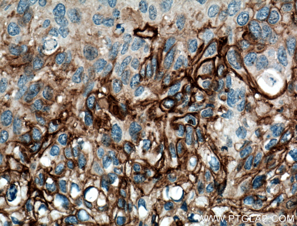 Immunohistochemistry (IHC) staining of human cervical cancer tissue using TGM1 Polyclonal antibody (12912-3-AP)