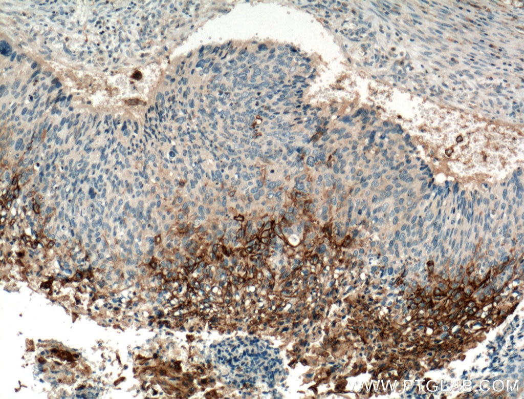 Immunohistochemistry (IHC) staining of human cervical cancer tissue using TGM1 Polyclonal antibody (12912-3-AP)