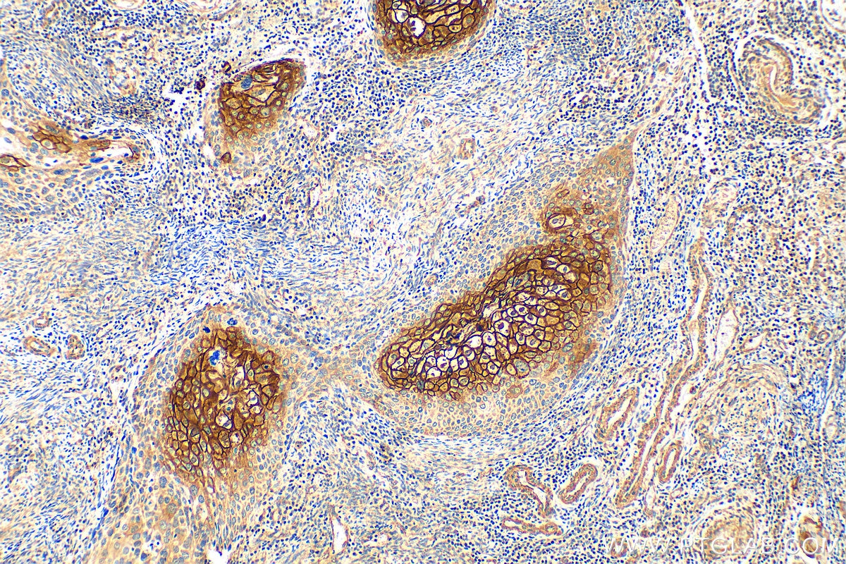 Immunohistochemistry (IHC) staining of human cervical cancer tissue using TGM1 Polyclonal antibody (12912-3-AP)