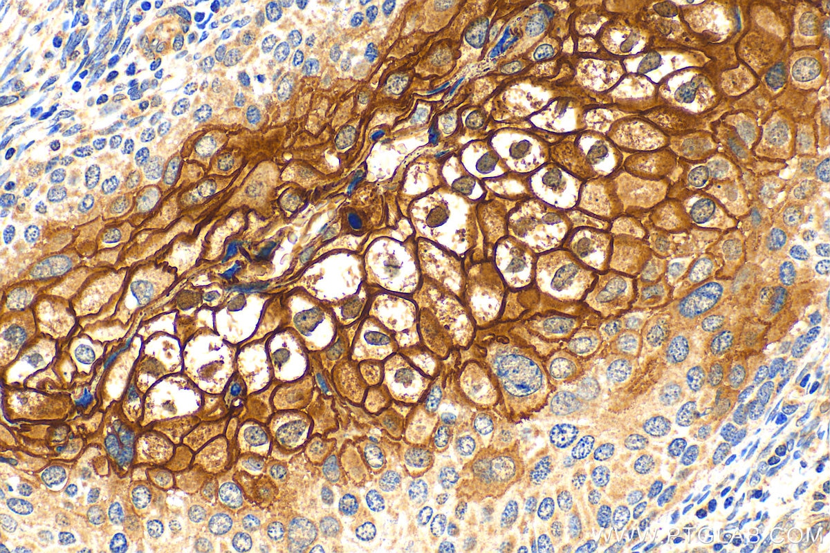 Immunohistochemistry (IHC) staining of human cervical cancer tissue using TGM1 Polyclonal antibody (12912-3-AP)