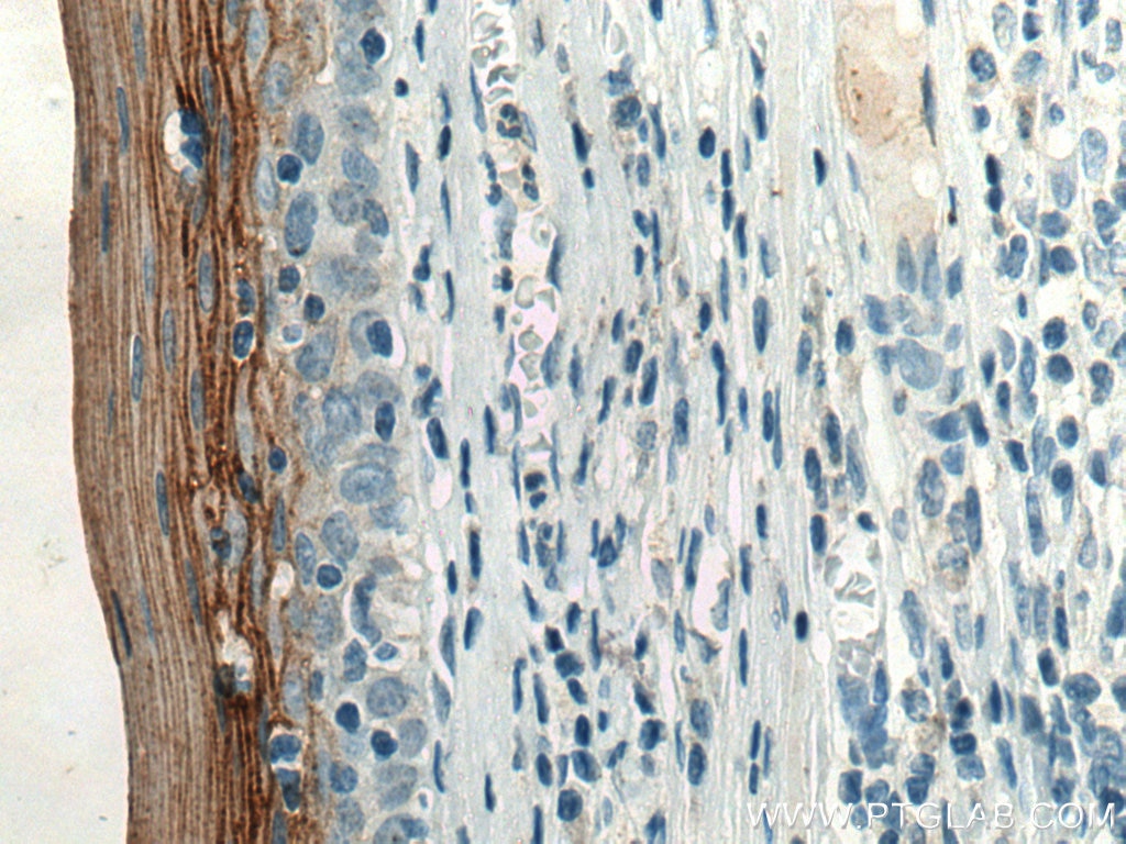 Immunohistochemistry (IHC) staining of human tonsillitis tissue using TGM1 Monoclonal antibody (67004-1-Ig)