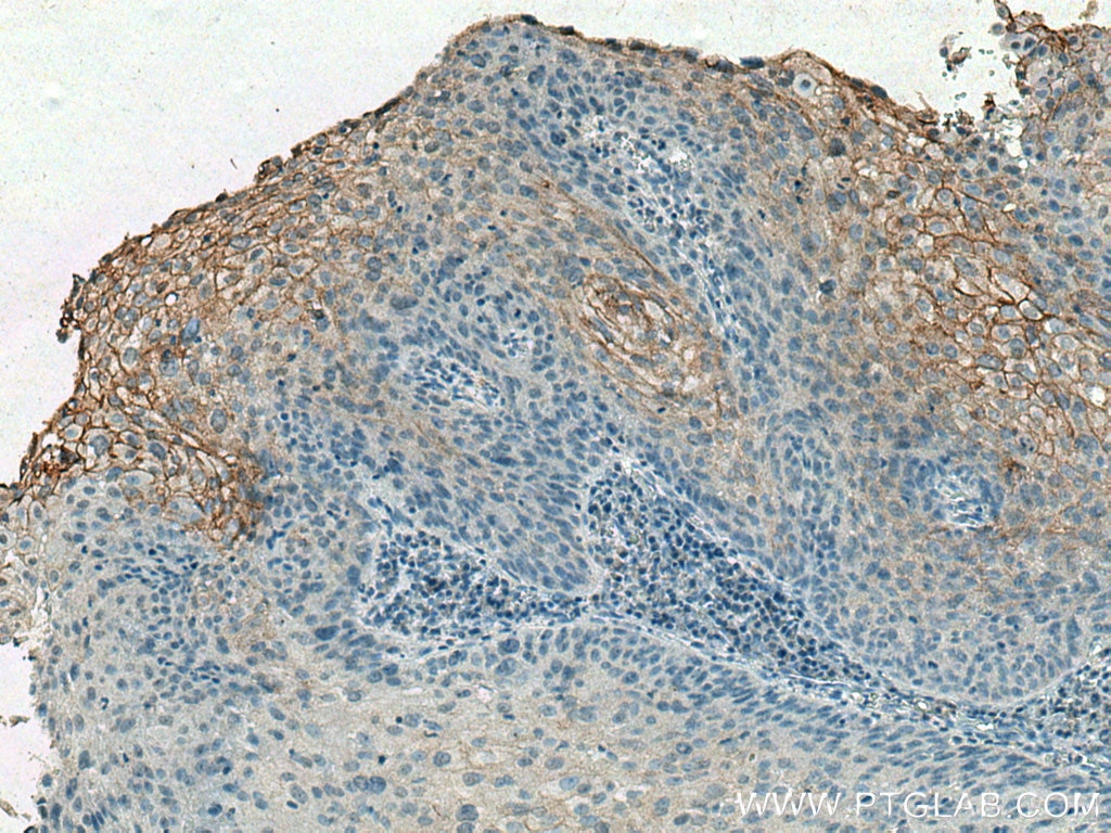 Immunohistochemistry (IHC) staining of human cervical cancer tissue using TGM1 Monoclonal antibody (67004-1-Ig)