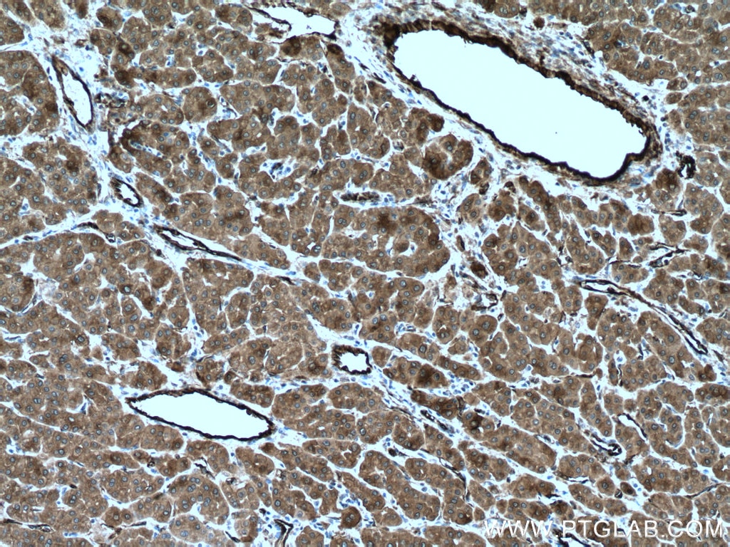 Immunohistochemistry (IHC) staining of human liver cancer tissue using TGM2 Polyclonal antibody (15100-1-AP)